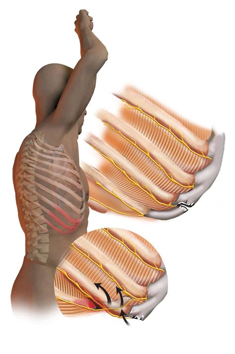 Surgical management of slipping rib syndrome penn medicine – Artofit