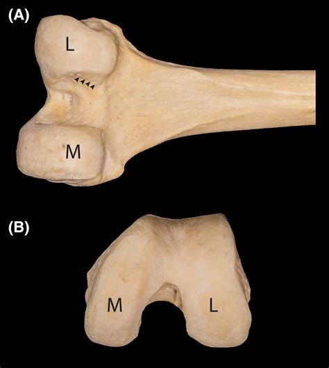 Intercondylar Notch