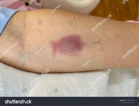 Bruise From Lab Draw at William Gainey blog