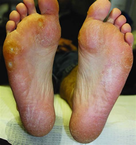 Tinea pedis, athlete's foot, causes, symptoms, diagnosis & treatment