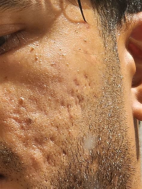 How can I fix these 'dents' : r/30PlusSkinCare