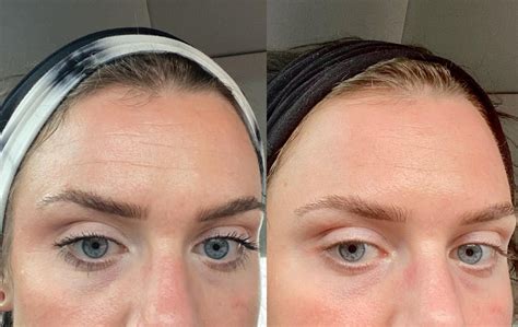 One week after 24 units of Botox. …my forehead was destroying every ounce of confidence I had. I ...
