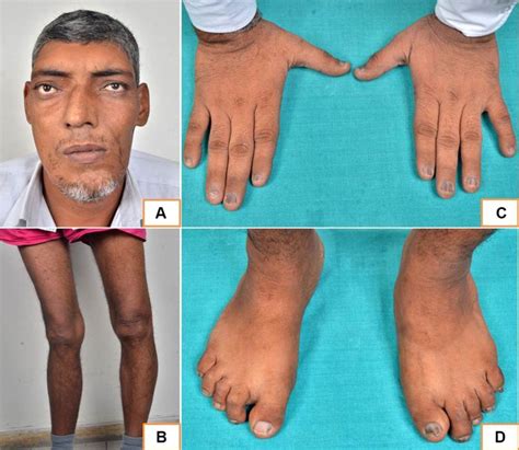 Symptoms Of Gigantism