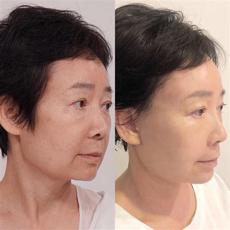 Constant runny nose months after rhinoplasty : r/PlasticSurgery