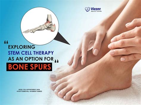 Exploring Stem Cell Therapy As An Option For Bone Spurs
