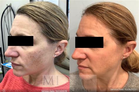 BBL Before & After Photos Patient 45 | Washington, DC | MI Skin ...