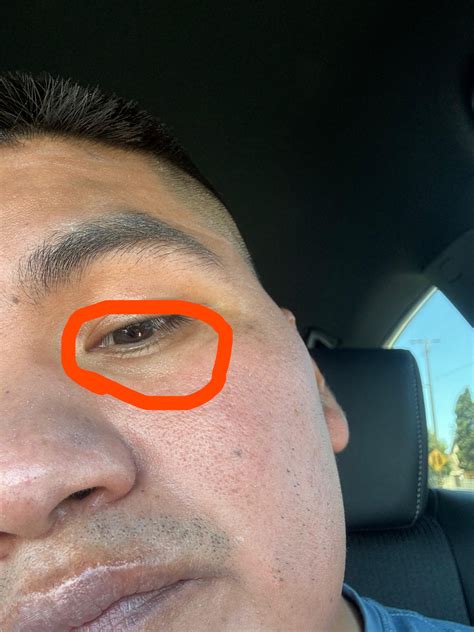 Small white bumps under eyes : r/DermatologyQuestions