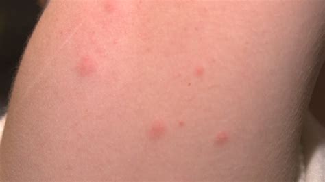 Tiny Black Bugs In House That Jump And Bite | Psoriasisguru.com