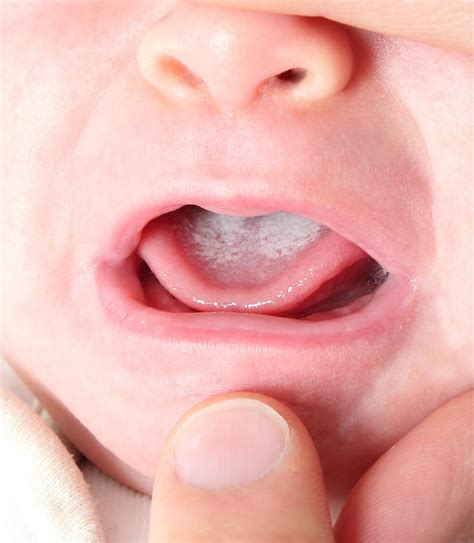 Oral Thrush Babies Breastfeeding