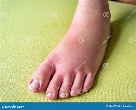Thick Foot after an Insect Bite Stock Image - Image of swelling, poisoning: 194475239