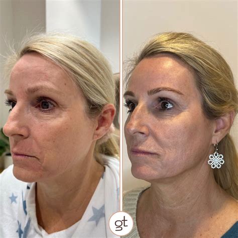 Before and After Gallery Dermal Fillers - Stunning Transformations