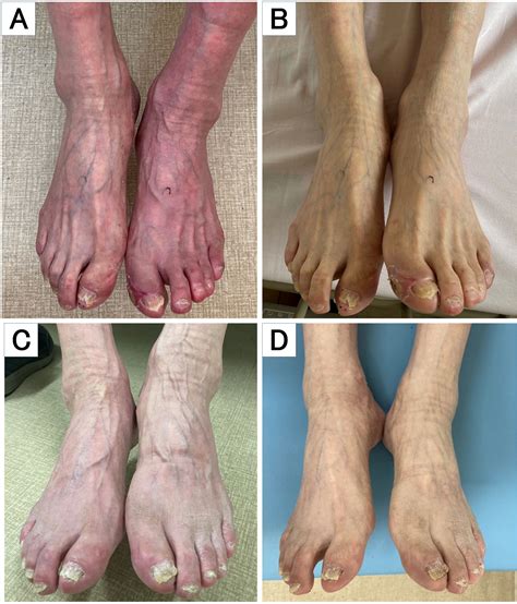 Resolution of Dependent Rubor after Revascularization for Peripheral ...