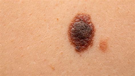 ¿Qué es el cáncer de piel melanoma? - Tu Salud