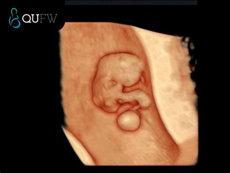8 Weeks Pregnant Ultrasound Is The Baby A Boy Based On The Ultrasound