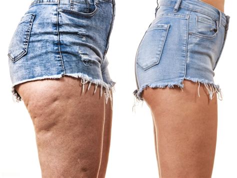 How to get rid of dimples in thighs | How to get rid of leg dimples ...