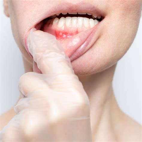 ¿Qué Hacer Si Tienes Una Llaga En La Encía?