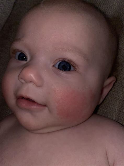 Red Cheeks During Teething Baby at Maria Baum blog