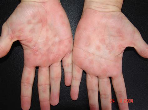 Stages Of Syphilis _ Syphilis: Symptoms, Causes, and Treatments – FNXR