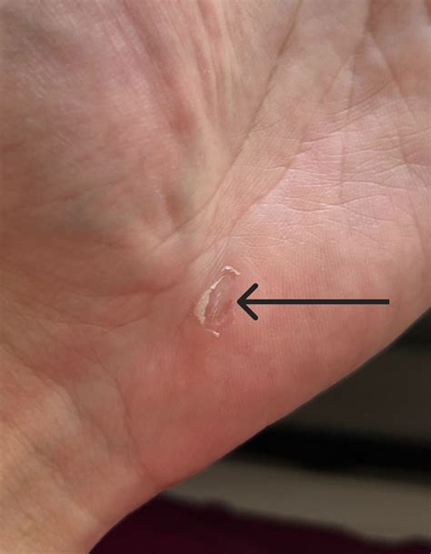 Beginning Of Warts On Hands