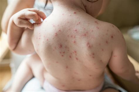 Chicken Pox Pictures In Adults