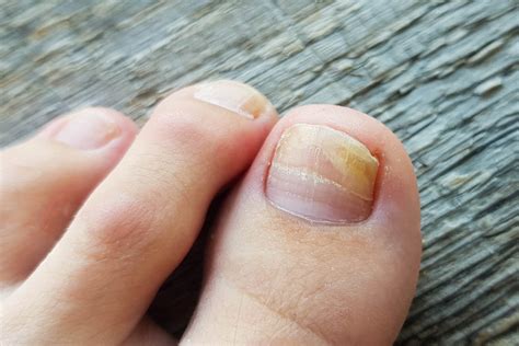 What If Your Toenail is Turning Black | Black Toenail Remedy