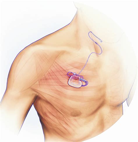 Sleep Apnea Treatment Obstructive Sleep Apnea Treatment Penn