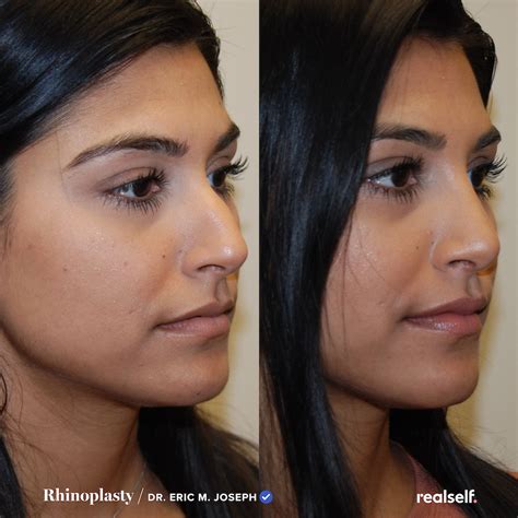 Rhinoplasty the ultimate guide to a nose job – Artofit