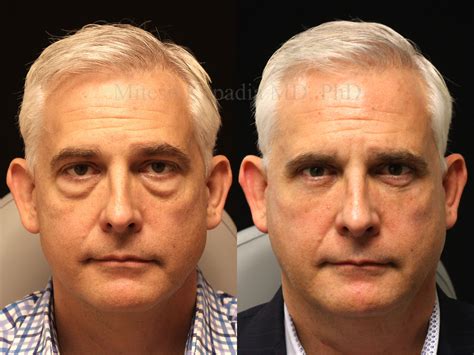 Before and nine months after lower blepharoplasty surgery | Boston ...