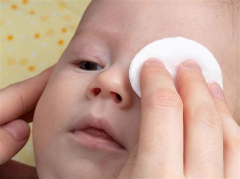 Newborn Eye Discharge