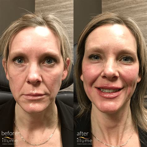 Cheek Filler - Illume Cosmetic Surgery & MedSpa