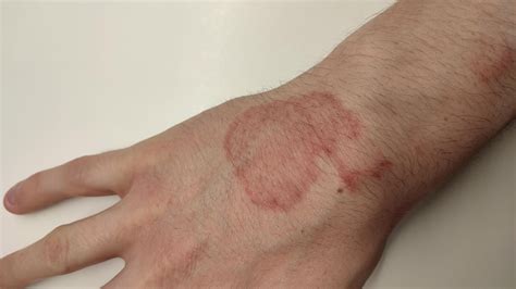 Ringworm or Eczema? : r/medical