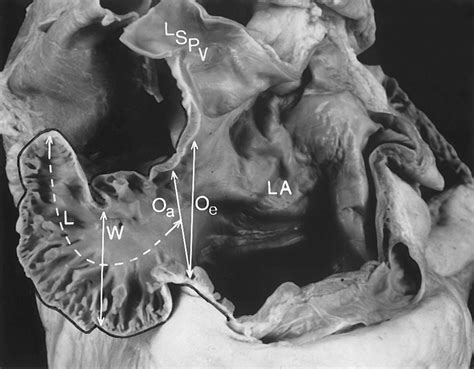 Anatomy of the Normal Left Atrial Appendage | Circulation