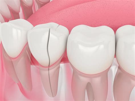 4 Ways to Fix a Cracked Tooth - Austin Laser Dentist - Helen Ragsdale DDS - Austin Dentist