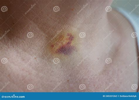Bruises on the Neck of a Woman As a Consequence of Laser Removal of a ...