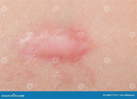 Surgical Removal Of Pyogenic Granuloma On Skin Royalty-Free Stock Photography | CartoonDealer ...