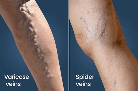 Varicose Veins Vs Spider Veins