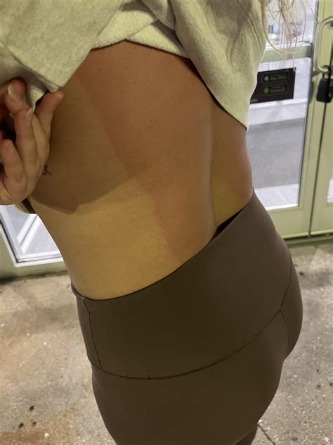 Rash after tanning : r/tanning