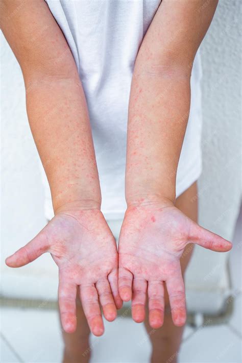 Premium Photo | Enterovirus leg arm mouth rash on the body of a child ...