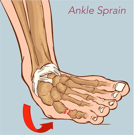 Symptoms Of Foot Sprain Or Fracture at Louise Collier blog