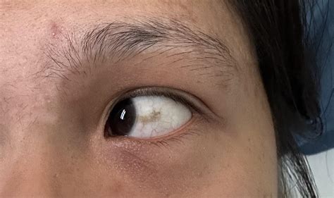 Brown Spot In Eye