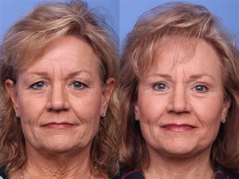 Best Facelift for Scottsdale & Phoenix, AZ – Hobgood Facial Plastic Surgery