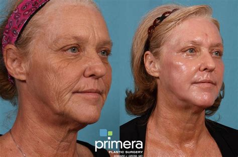 Exuviance Peel Before And After / Jessner Chemical Peel: Before/After Photos of the Proven ...