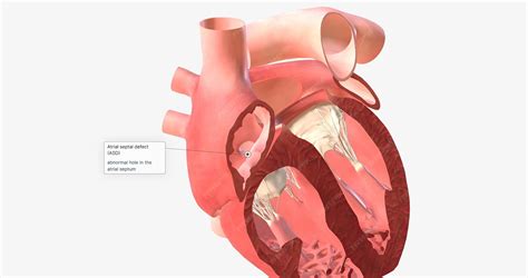 Premium Photo | An atrial septal defect is an abnormal hole in the ...
