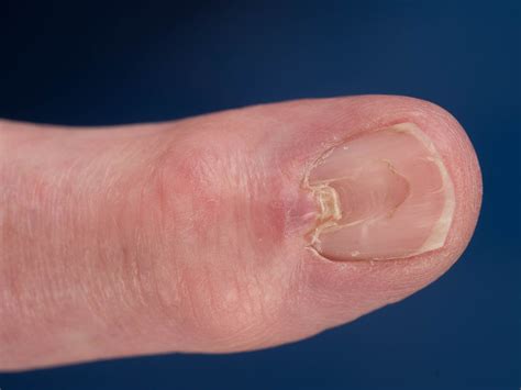 Digital Mucous Cyst at Janis Clayson blog