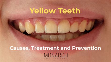 Yellow teeth (yellow spots on teeth): cause, treatment, prevention