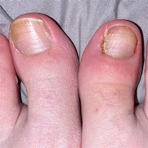 Retronychia after partial nail avulsion : r/Ingrown_Toenails