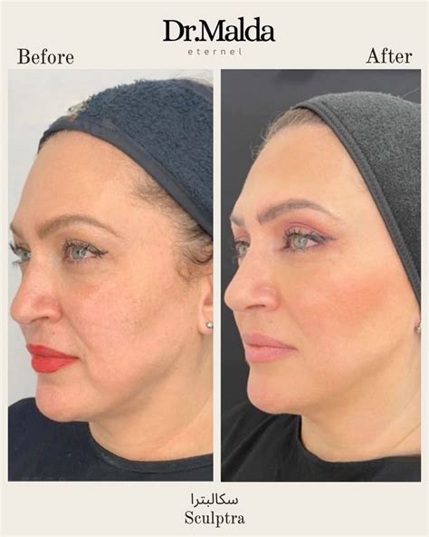 Sculptra Filler Treatment | Dr Malda Aldaoudi