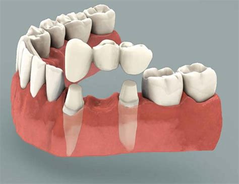 symptoms of ill-fitting dental bridge