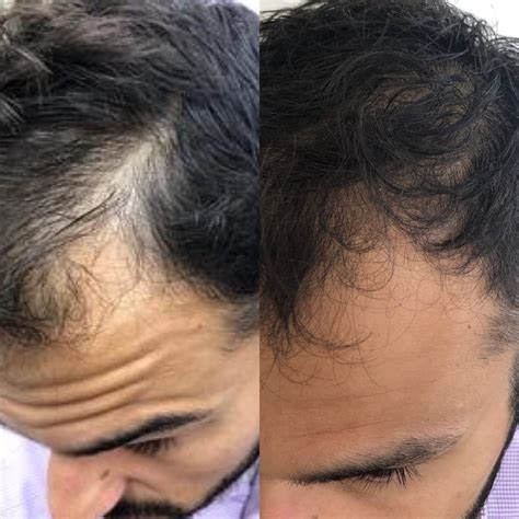 What Is Hair Restoration Treatment at Gary Briscoe blog