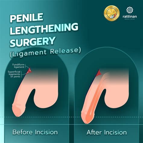 Penis Size Increase Surgery